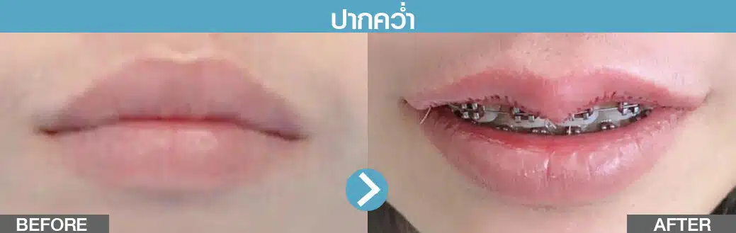 รีวิวปากกระจับ