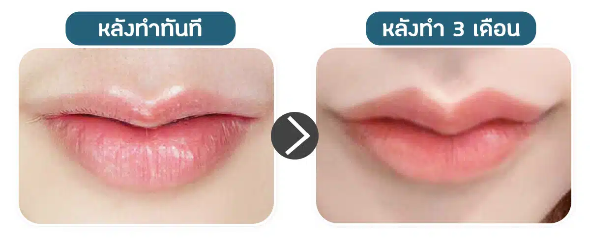 คลายตัว ปากกระจับ