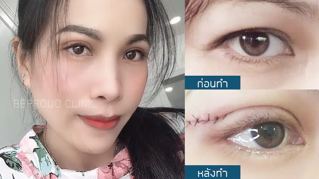 เทคนิค ยกหางหงส์