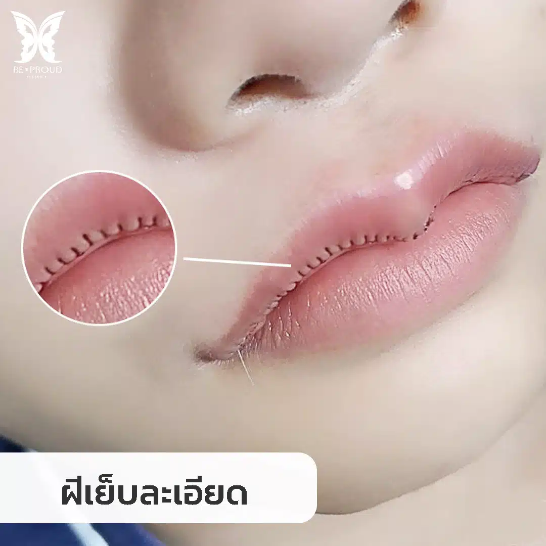 ฝีเย็บละเอียด