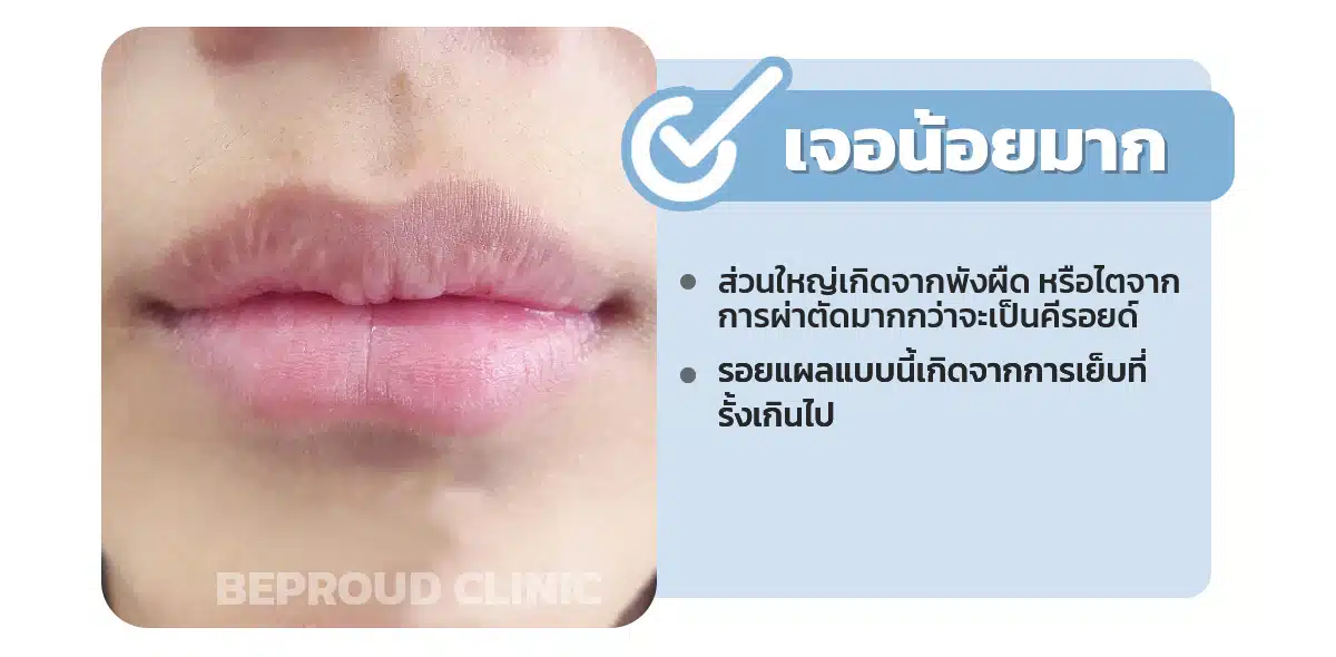 ทำปากจะเป็นคีลอยด์มั้ย