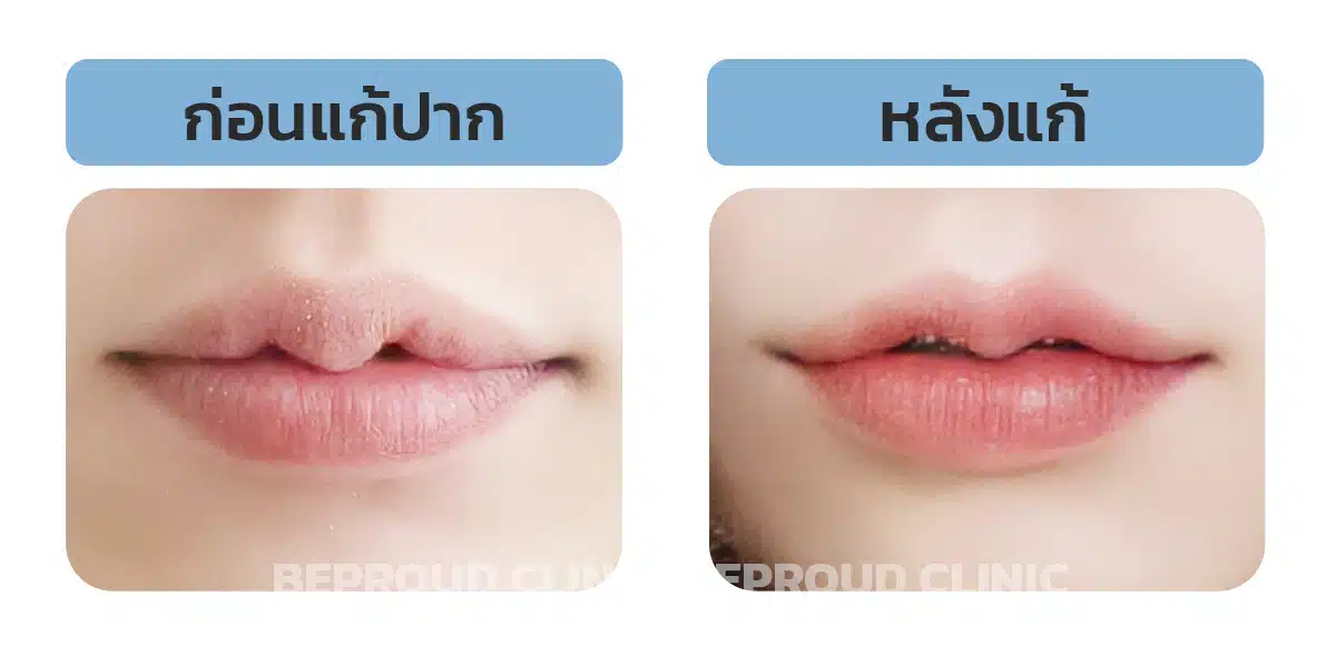 ทำปากมาแก้ปากได้มั้ย