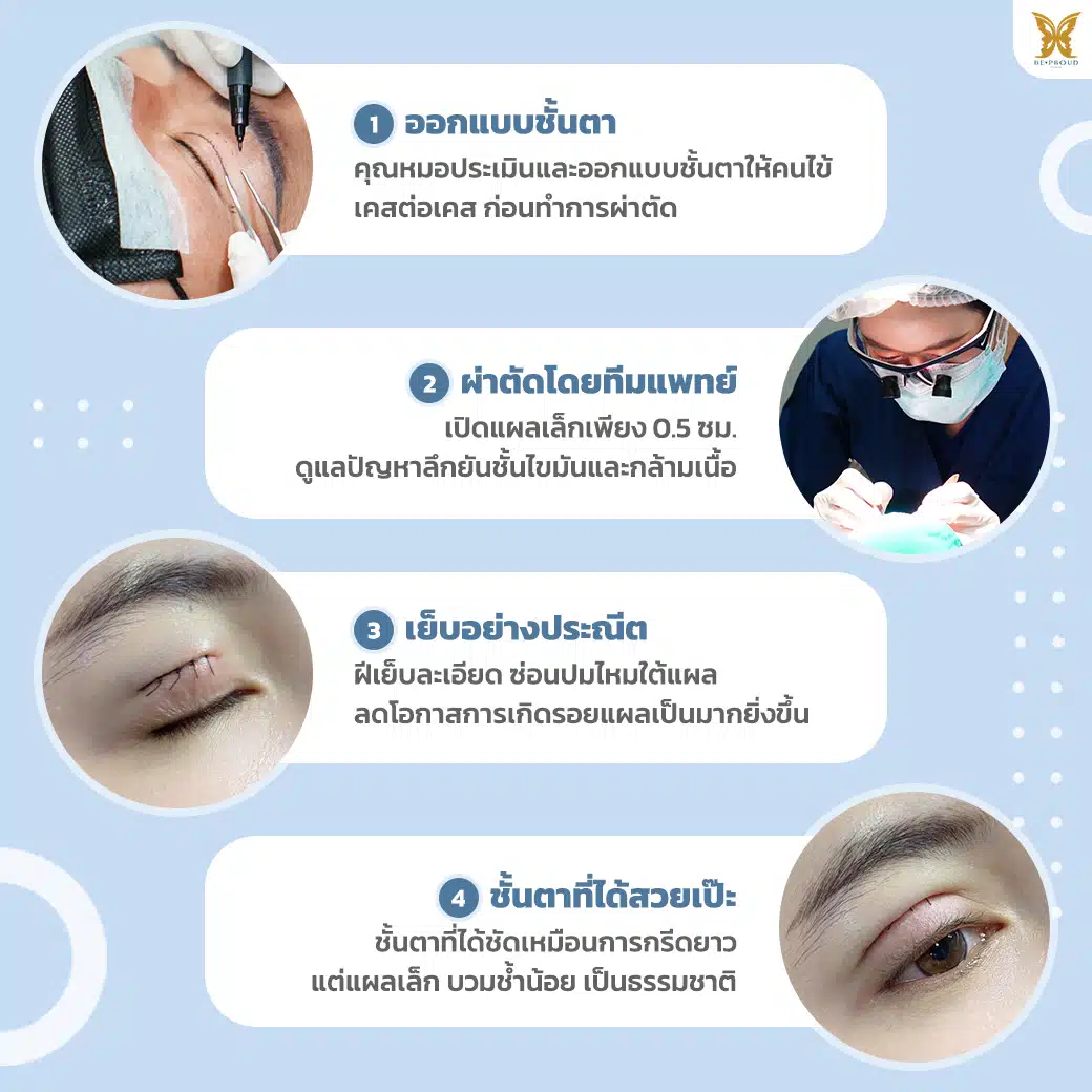 ขั้นตอนการทำตา_ทำตาสองชั้น กรีดยาวแผลมินิ