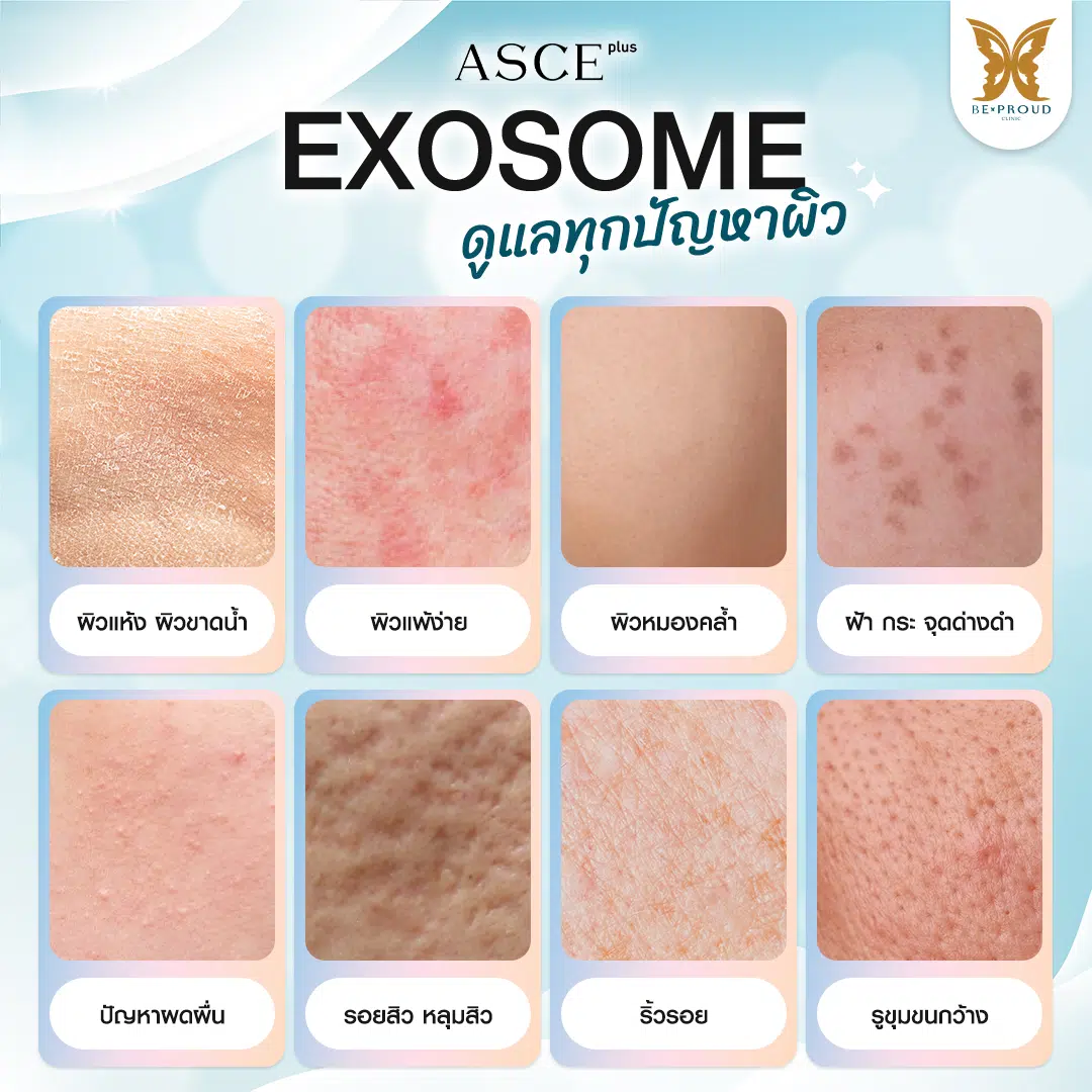 Exosome เหมาะกับใคร