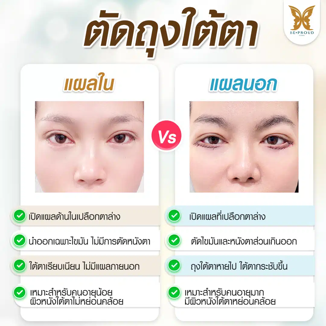 ตัดถุงใต้ตา