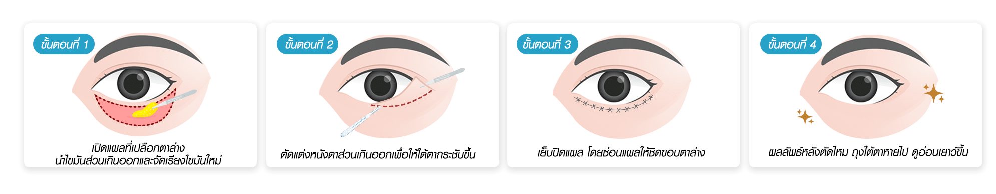 ตัดถุงใต้ตาแผลนอก