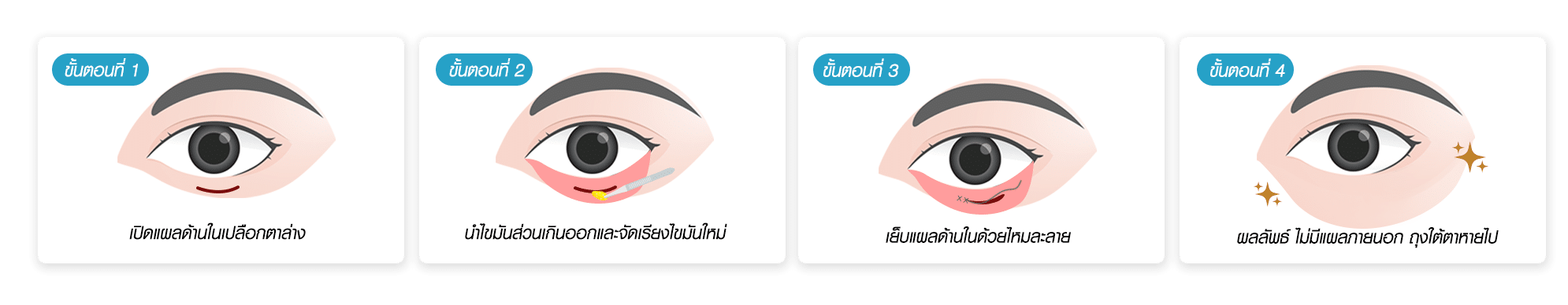 ตัดถุงใต้ตาแผลใน