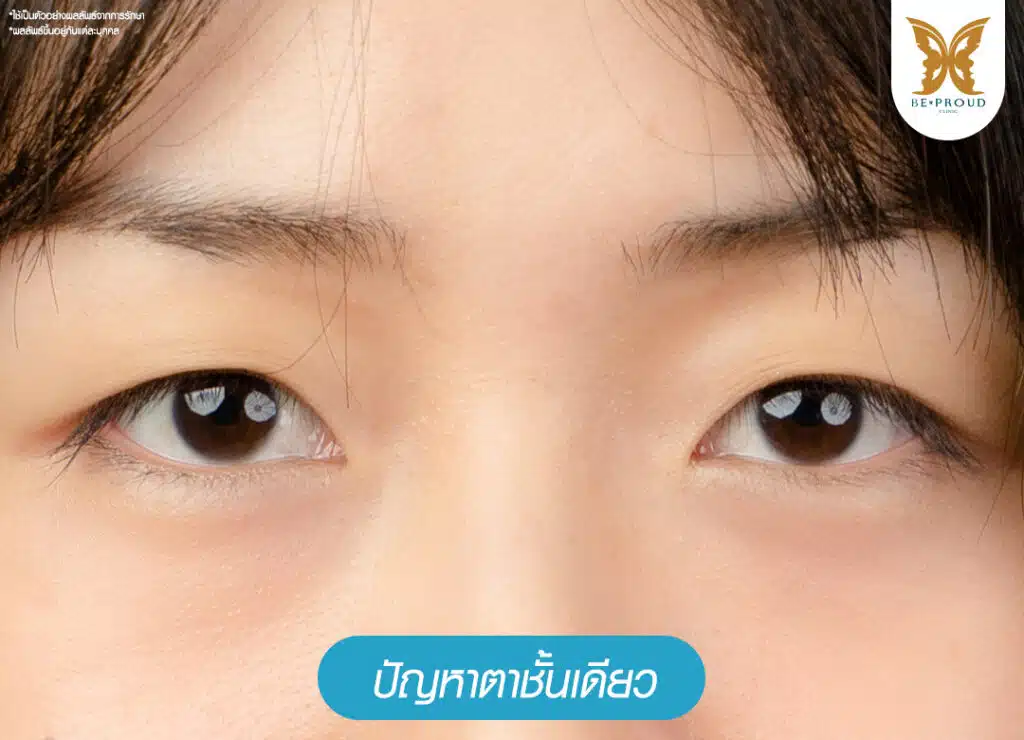 แก้ตาชั้นเดียว