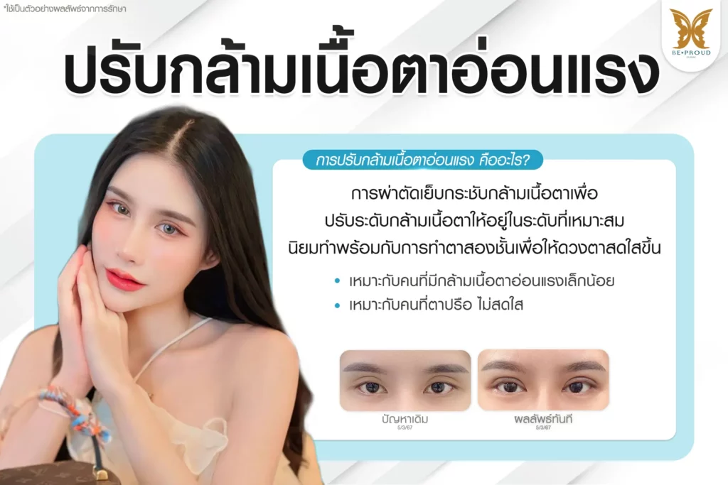 ปรับกล้ามเนื้อตาอ่อนแรง