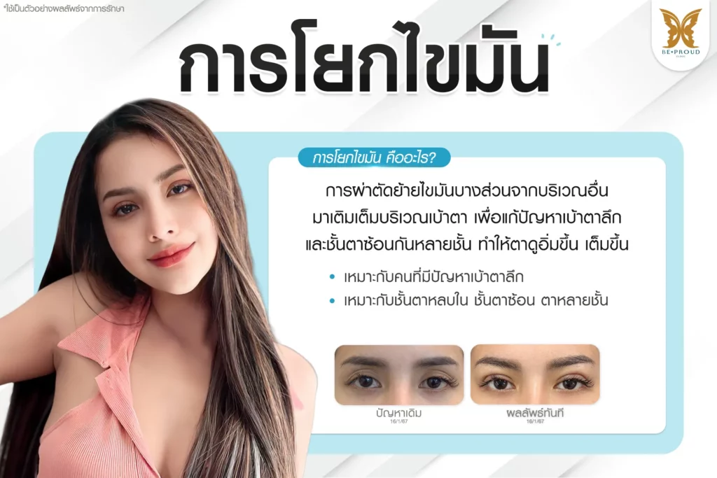 การโยกไขมัน